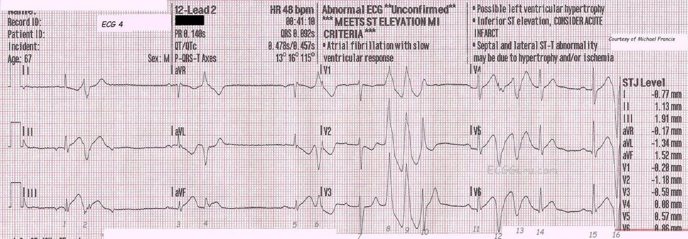 Teaching Series 112213 Inferior Posterior Wall M I With Right